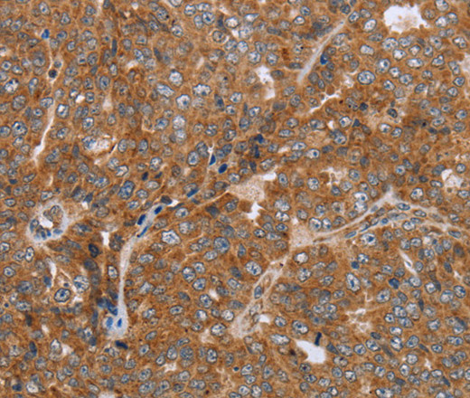 Immunohistochemistry of paraffin-embedded Human ovarian cancer using NDUFS2 Polyclonal Antibody at dilution of 1:50