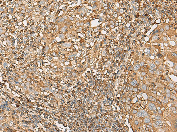 Immunohistochemistry of paraffin-embedded Human cervical cancer tissue  using UBE2A Polyclonal Antibody at dilution of 1:55(?200)