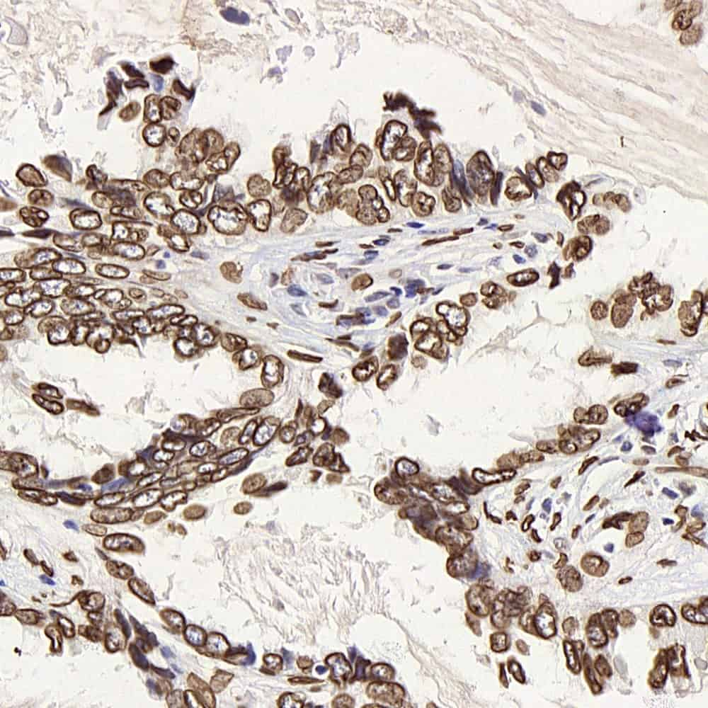 Immunohistochemistry analysis of paraffin-embedded human lung cancer  using LMNA Polyclonal Antibody at dilution of 1:300.