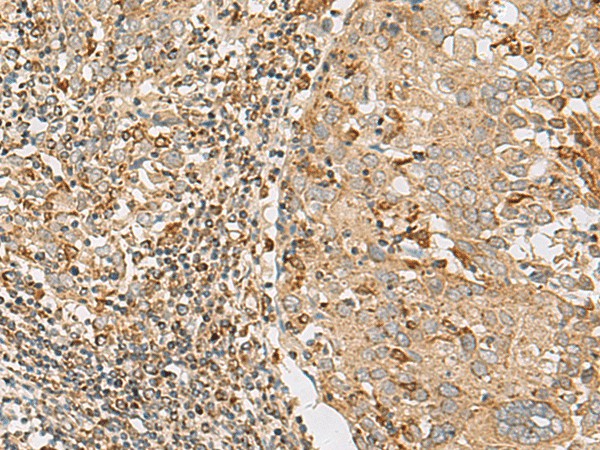 Immunohistochemistry of paraffin-embedded Human cervical cancer tissue  using ZC3H7A Polyclonal Antibody at dilution of 1:50(?200)