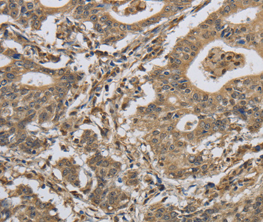 Immunohistochemistry of paraffin-embedded Human gastic cancer using IPO7 Polyclonal Antibody at dilution of 1:40