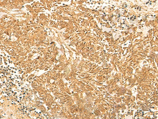 Immunohistochemistry of paraffin-embedded Human lung cancer tissue  using KRT76 Polyclonal Antibody at dilution of 1:30(?200)