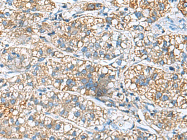 Immunohistochemistry of paraffin-embedded Human liver cancer tissue  using JOSD1 Polyclonal Antibody at dilution of 1:90(?200)