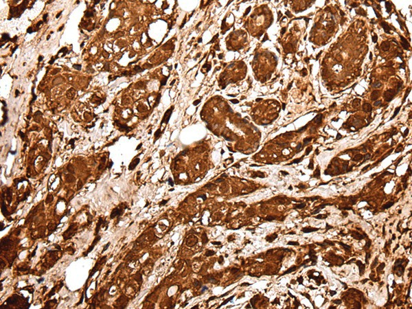 Immunohistochemistry of paraffin-embedded Human breast cancer tissue  using VCP Polyclonal Antibody at dilution of 1:30(?200)