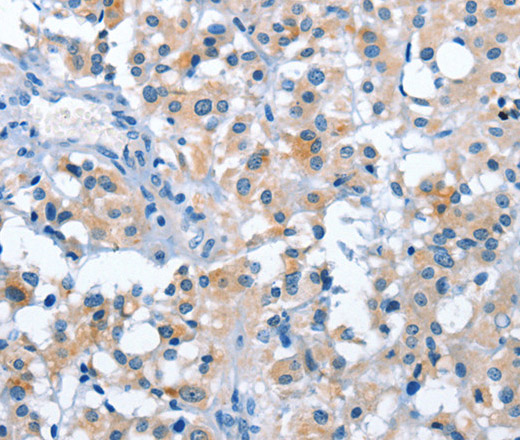 Immunohistochemistry of paraffin-embedded Human thyroid cancer tissue using ASB2 Polyclonal Antibody at dilution 1:50