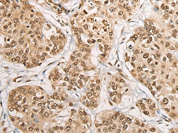 Immunohistochemistry of paraffin-embedded Human prost at e cancer tissue  using PHF21A Polyclonal Antibody at dilution of 1:50(?200)