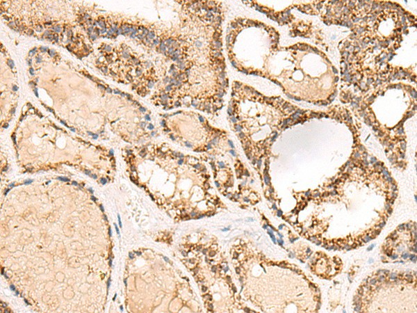 Immunohistochemistry of paraffin-embedded Human thyroid cancer tissue  using ECH1 Polyclonal Antibody at dilution of 1:50(?200)