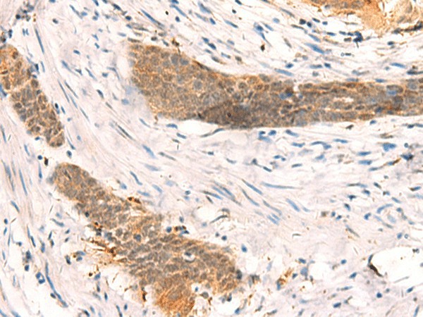 Immunohistochemistry of paraffin-embedded Human esophagus cancer tissue  using SETD1A Polyclonal Antibody at dilution of 1:40(?200)