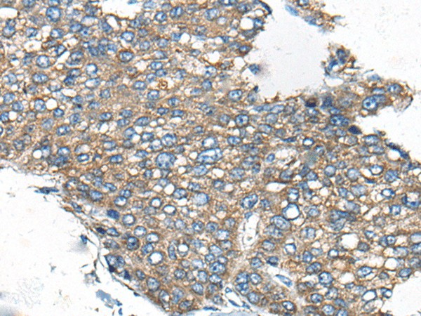 Immunohistochemistry of paraffin-embedded Human liver cancer tissue  using CDC42BPA Polyclonal Antibody at dilution of 1:60(?200)