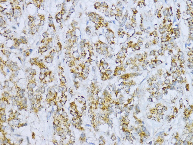 Immunohistochemistry of paraffin-embedded Human colon carcinoma using Aconitase 2 (ACO2) Polyclonal antibody at dilution of 1:100 (40x lens).Perform microwave antigen retrieval with 10 mM PBS buffer pH 7.2 before commencing with IHC staining protocol.