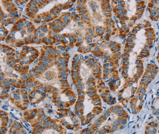 Immunohistochemistry of paraffin-embedded Human thyroid cancer using MTCH2 Polyclonal Antibody at dilution of 1:45