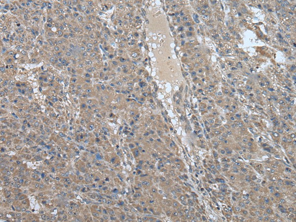 Immunohistochemistry of paraffin-embedded Human liver cancer tissue  using USP32 Polyclonal Antibody at dilution of 1:75(?200)