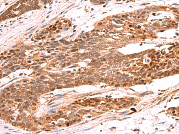 Immunohistochemistry of paraffin-embedded Human esophagus cancer tissue  using RRP8 Polyclonal Antibody at dilution of 1:80(?200)