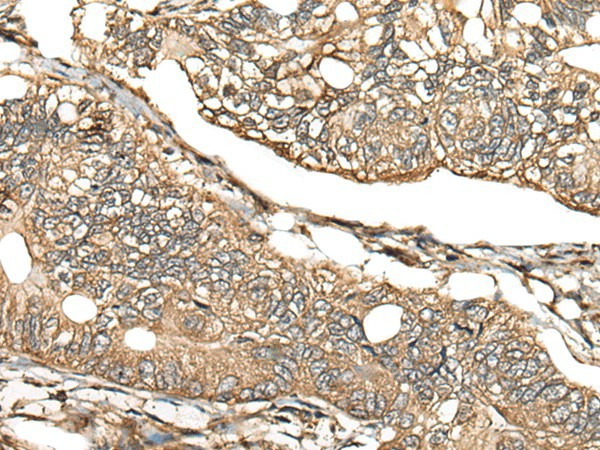 Immunohistochemistry of paraffin-embedded Human gastric cancer tissue  using CA11 Polyclonal Antibody at dilution of 1:30(?200)