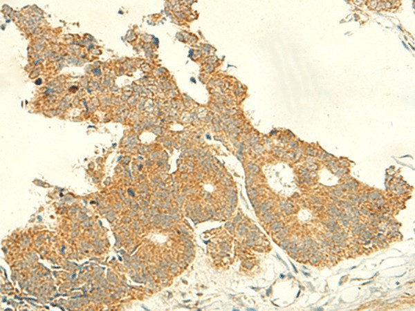 Immunohistochemistry of paraffin-embedded Human colorectal cancer tissue  using IFT27 Polyclonal Antibody at dilution of 1:50(?200)