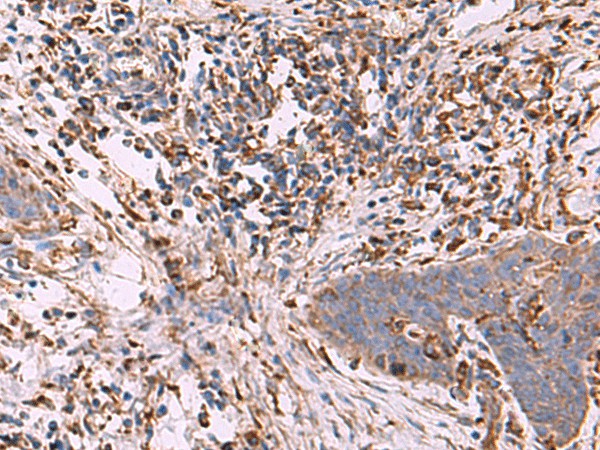 Immunohistochemistry of paraffin-embedded Human esophagus cancer tissue  using G6PC Polyclonal Antibody at dilution of 1:70(?200)