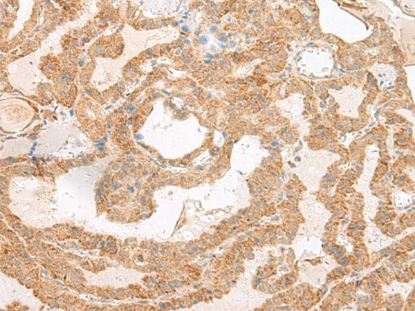 Immunohistochemistry of paraffin-embedded Human thyroid cancer tissue  using SLC6A9 Polyclonal Antibody at dilution of 1:50(?200)