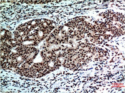 Immunohistochemistry of paraffin-embedded Human breast carcinoma tissue using BECN1 Monoclonal Antibody at dilution of 1:200.