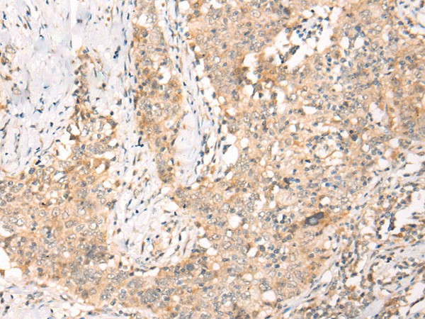 Immunohistochemistry of paraffin-embedded Human esophagus cancer tissue  using YRDC Polyclonal Antibody at dilution of 1:30(?200)