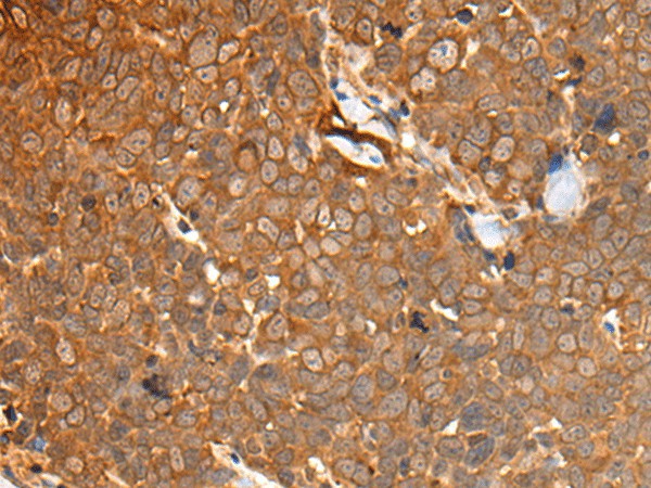 Immunohistochemistry of paraffin-embedded Human thyroid cancer tissue  using CAD Polyclonal Antibody at dilution of 1:50(?200)