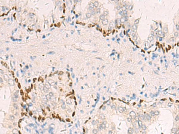 Immunohistochemistry of paraffin-embedded Human prost at e cancer tissue  using TP63 Polyclonal Antibody at dilution of 1:40(?200)