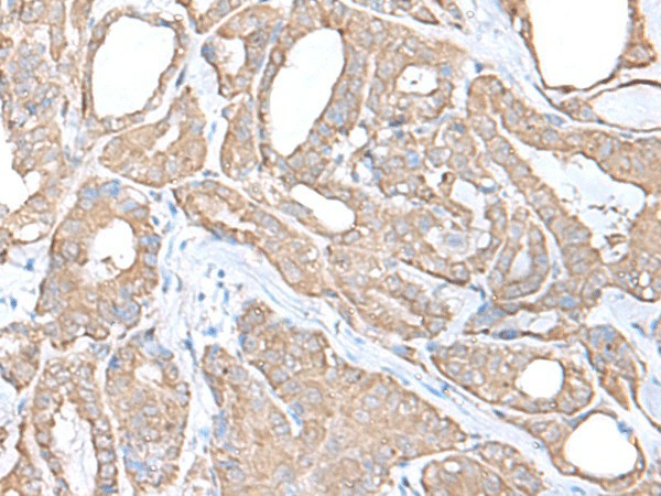 Immunohistochemistry of paraffin-embedded Human thyroid cancer tissue  using C9orf116 Polyclonal Antibody at dilution of 1:55(?200)