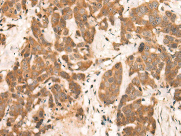 Immunohistochemistry of paraffin-embedded Human thyroid cancer tissue  using NRG2 Polyclonal Antibody at dilution of 1:65(?200)