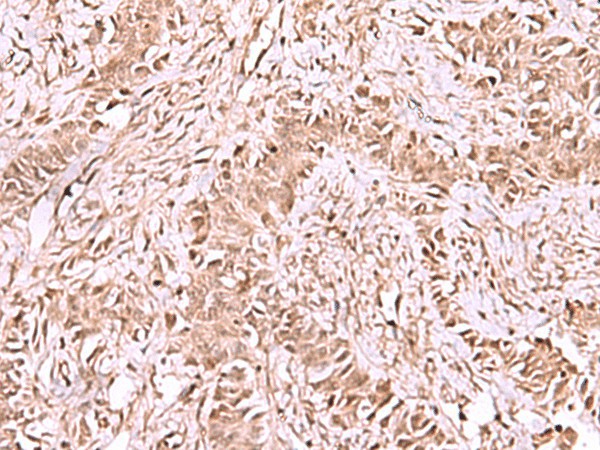 Immunohistochemistry of paraffin-embedded Human ovarian cancer tissue  using CDKN1B Polyclonal Antibody at dilution of 1:75(?200)