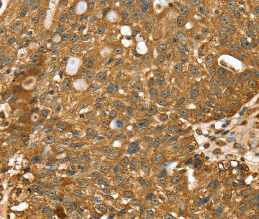 Immunohistochemistry of paraffin-embedded Human breast cancer using STARD5 Polyclonal Antibody at dilution of 1:40