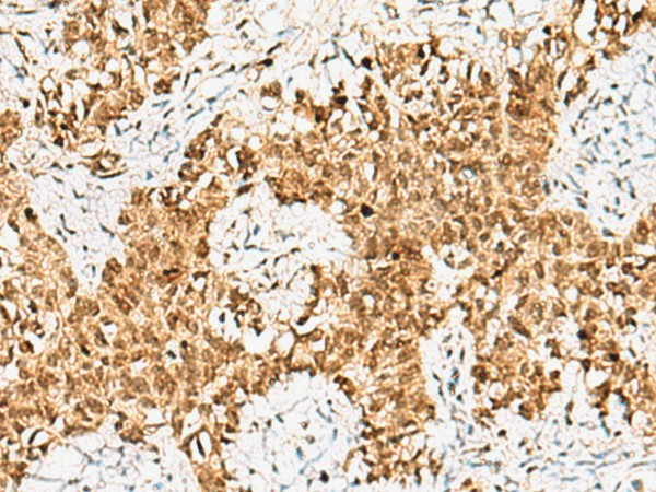 Immunohistochemistry of paraffin-embedded Human ovarian cancer tissue  using CRCP Polyclonal Antibody at dilution of 1:65(?200)