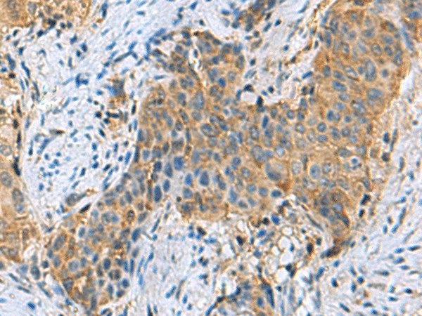 Immunohistochemistry of paraffin-embedded Human cervical cancer tissue  using PSMA6 Polyclonal Antibody at dilution of 1:90(?200)