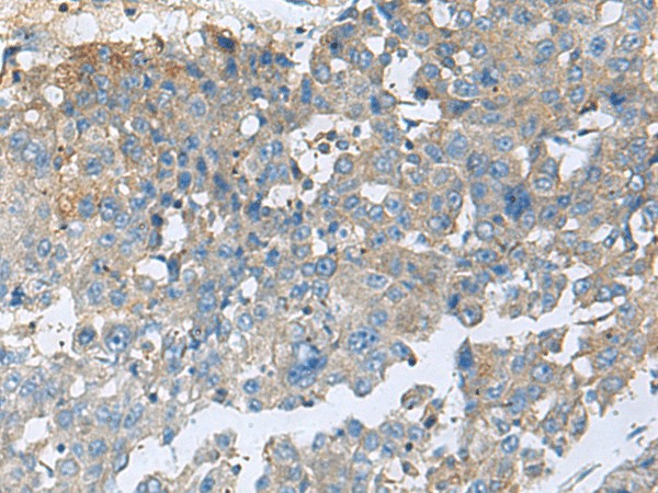 Immunohistochemistry of paraffin-embedded Human liver cancer tissue  using CEMIP Polyclonal Antibody at dilution of 1:60(?200)