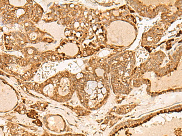 Immunohistochemistry of paraffin-embedded Human thyroid cancer tissue  using HIRIP3 Polyclonal Antibody at dilution of 1:60(?200)