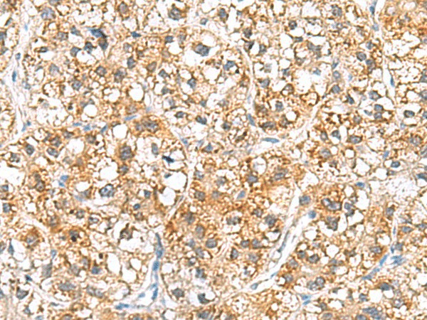 Immunohistochemistry of paraffin-embedded Human liver cancer tissue  using RIDA Polyclonal Antibody at dilution of 1:70(?200)