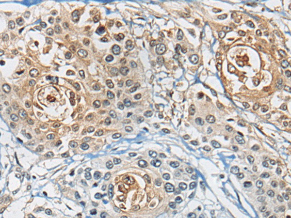 Immunohistochemistry of paraffin-embedded Human prost at e cancer tissue  using CD8A Polyclonal Antibody at dilution of 1:100(?200)