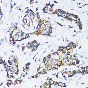 Immunohistochemistry of paraffin-embedded Human breast cancer using ATG7 Polyclonal Antibody at dilution of 1:100 (40x lens).