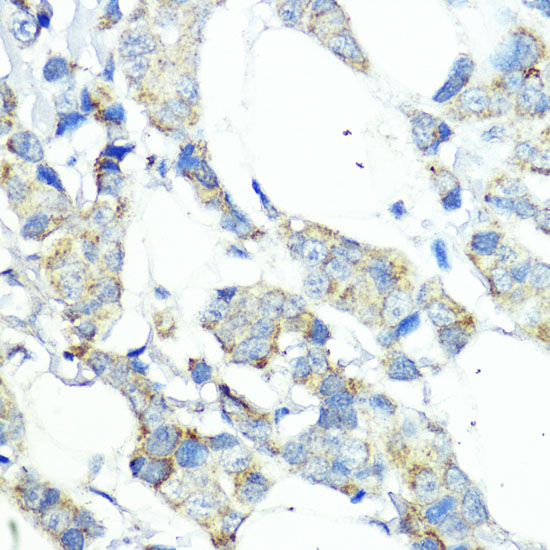 Immunohistochemistry of paraffin-embedded Human mammary cancer using NOD1 Polyclonal Antibody at dilution of 1:100 (40x lens).