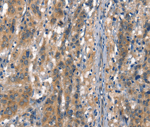 Immunohistochemistry of paraffin-embedded Human gastric cancer tissue using VE-Cadherin Polyclonal Antibody at dilution 1:50