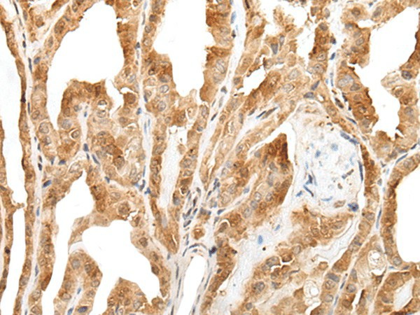 Immunohistochemistry of paraffin-embedded Human thyroid cancer tissue  using ZPBP Polyclonal Antibody at dilution of 1:30(?200)