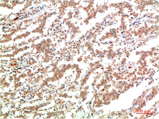 Immunohistochemistry of paraffin-embedded Human lung carcinoma tissue using JAK2 Monoclonal Antibody at dilution of 1:200.