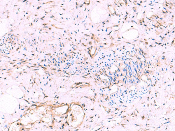 Immunohistochemistry of paraffin-embedded Human cervical cancer tissue  using KATNAL1 Polyclonal Antibody at dilution of 1:95(?200)