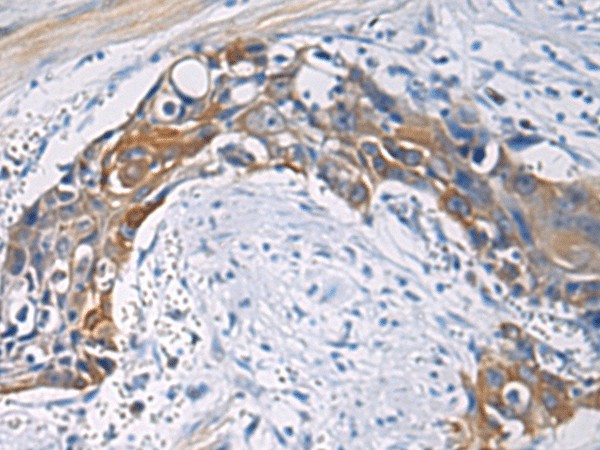 Immunohistochemistry of paraffin-embedded Human esophagus cancer tissue  using CEP89 Polyclonal Antibody at dilution of 1:100(?200)