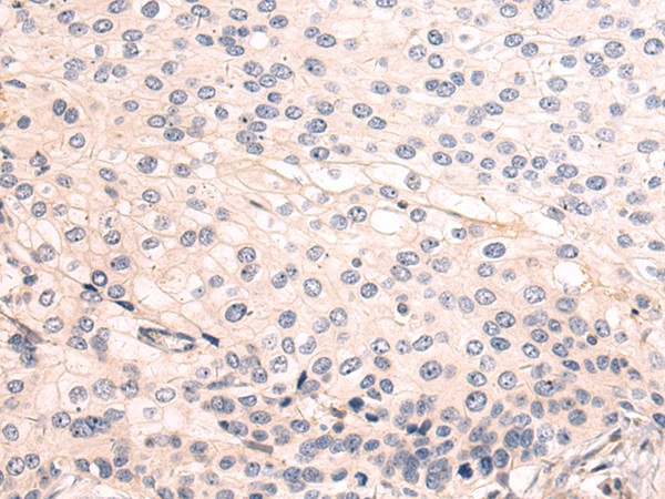 Immunohistochemistry of paraffin-embedded Human cervical cancer tissue using LRRC15 Polyclonal Antibody at dilution 1:50