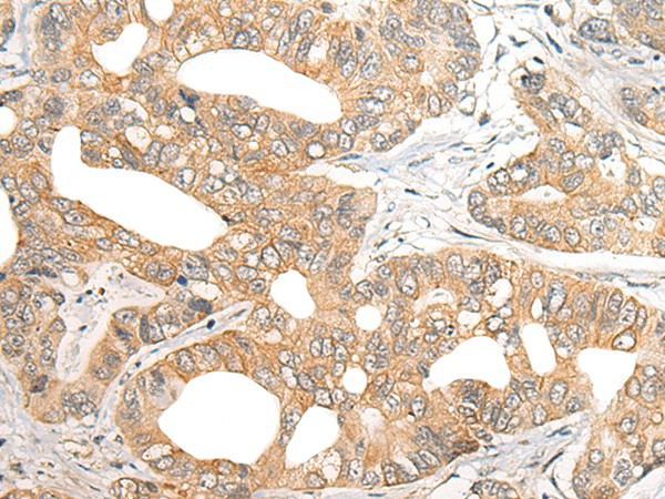 Immunohistochemistry of paraffin-embedded Human gastric cancer tissue  using SNX6 Polyclonal Antibody at dilution of 1:40(?200)