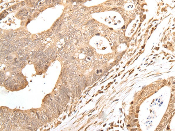 Immunohistochemistry of paraffin-embedded Human gastric cancer tissue  using GRAP Polyclonal Antibody at dilution of 1:40(?200)