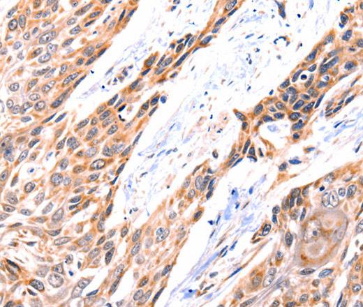 Immunohistochemistry of paraffin-embedded Human esophagus cancer using GNRHR Polyclonal Antibody at dilution of 1:117