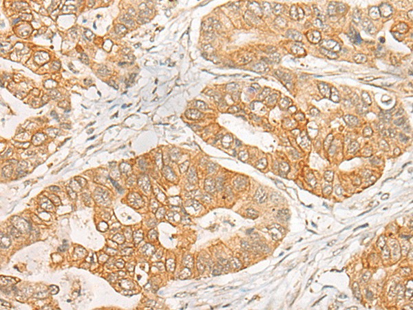 Immunohistochemistry of paraffin-embedded Human gastric cancer tissue  using GNB1L Polyclonal Antibody at dilution of 1:35(?200)