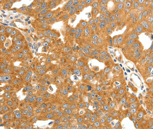 Immunohistochemistry of paraffin-embedded Human ovarian cancer tissue using SCT Polyclonal Antibody at dilution 1:60