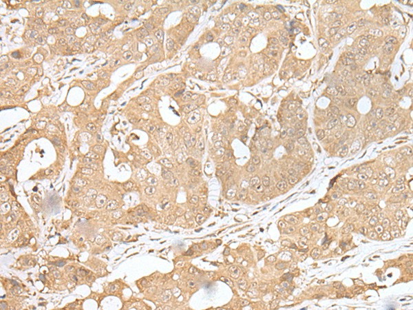 Immunohistochemistry of paraffin-embedded Human gastric cancer tissue  using SMARCA1 Polyclonal Antibody at dilution of 1:30(?200)