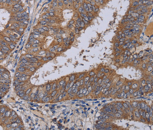 Immunohistochemistry of paraffin-embedded Human colon cancer using ZC3H12A Polyclonal Antibody at dilution of 1:40